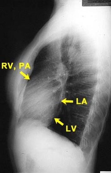 Normal Chest X-ray