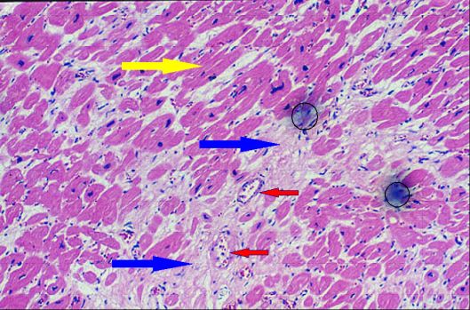 Myocardial Infarction, Old (Microscopic)