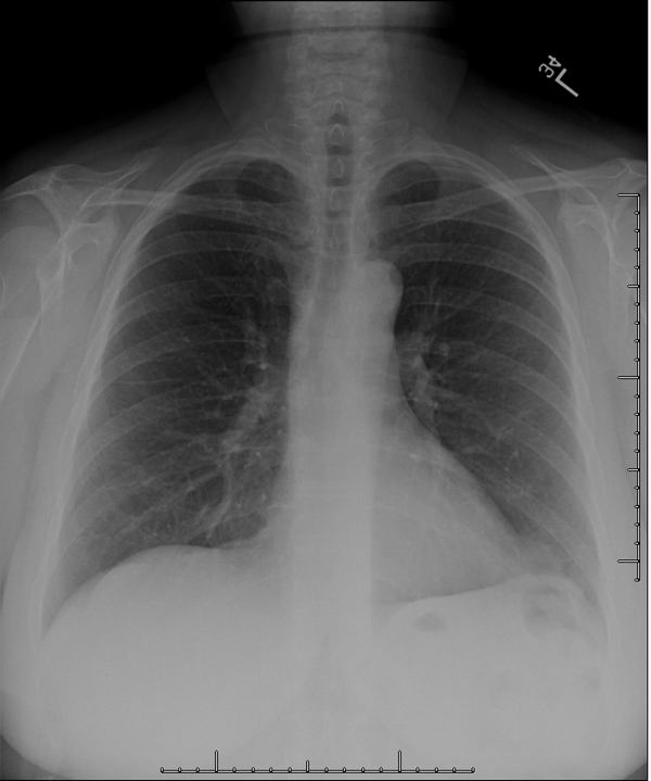 Chest X-ray 1, PA
